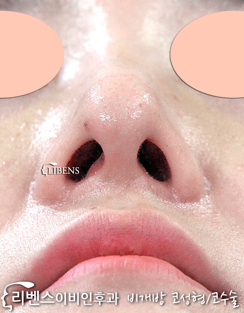 무보형물 매부리코 메부리코 복코 코끝 교정 성형 수술 연골묶기 성형 s588